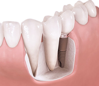dental implant restoration